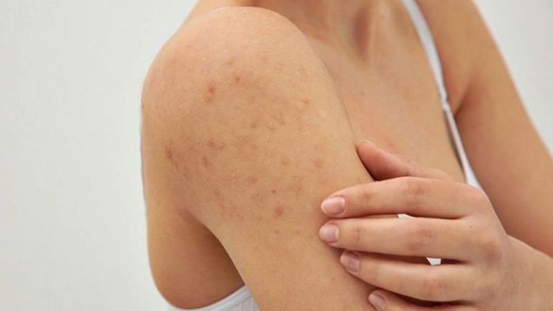 Dùng tay gãi vào vùng da mắc u mềm lây sẽ làm virus lây lan sang các bộ phận khác Dùng tay gãi vào vùng da mắc u mềm lây sẽ làm virus lây lan sang các bộ phận khác