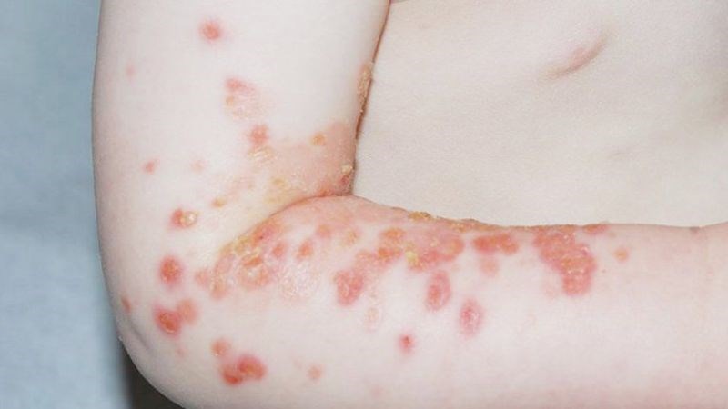 U mềm lây có thể gây nhiễm trùng da (chốc, lở) U mềm lây có thể gây nhiễm trùng da (chốc, lở)