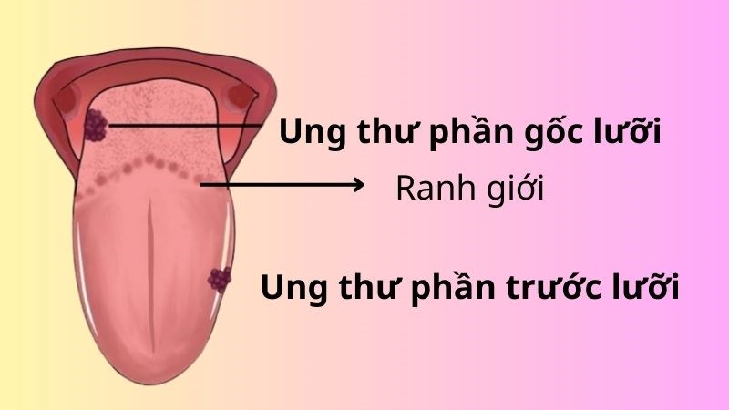 Ung thư lưỡi: Nguyên nhân, dấu hiệu phát hiện và cách phòng ngừa