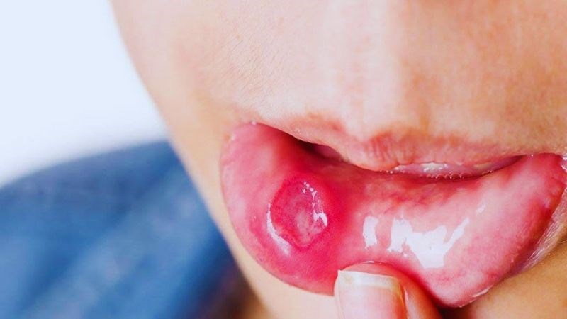 Dấu hiệu sớm của ung thư lưỡi có thể là vết loét không lành