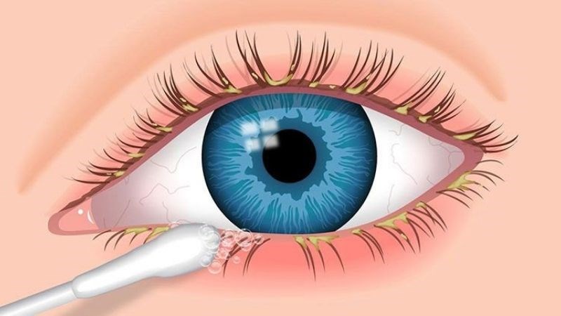 Viêm bờ mi mắt là mí mắt có màu đỏ hoặc sẫm màu, sưng tấy và phù
