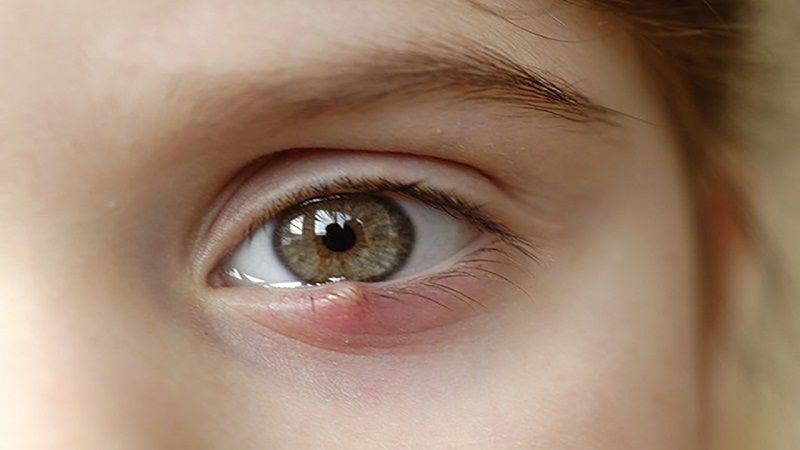 Viêm bờ mi mắt có thể gây ra tình trạng lẹo mắt