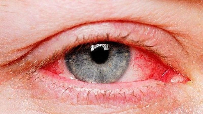 Mắt đỏ là dấu hiệu của viêm bờ mi mắt