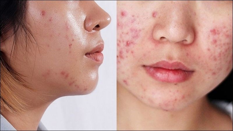 Người có làn da dầu là nguyên nhân gây ra tình trạng viêm bã dầu