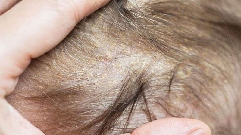 Trẻ em bị viêm da tiết bã thường xuất hiện những mảng màu vàng, nâu hoặc trắng