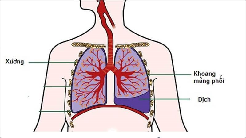 Viêm màng phổi có thể dẫn tới tràn dịch màng phổi Viêm màng phổi có thể dẫn tới tràn dịch màng phổi