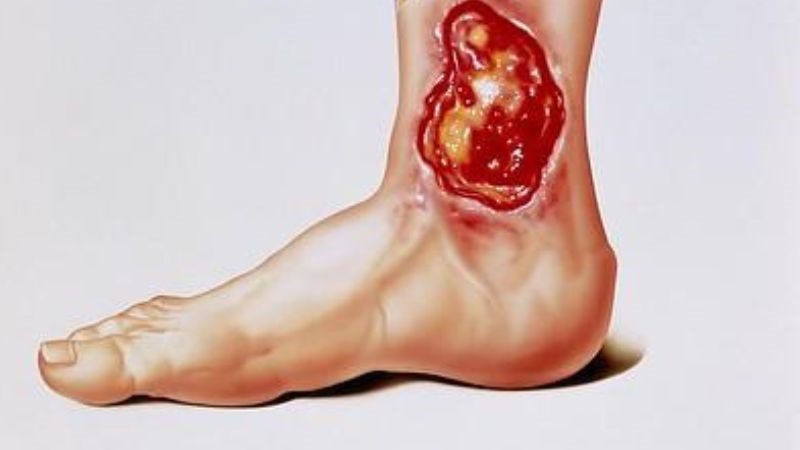 Vết thương nhiễm trùng là yếu tố nguy cơ dẫn đến viêm mô tế bào