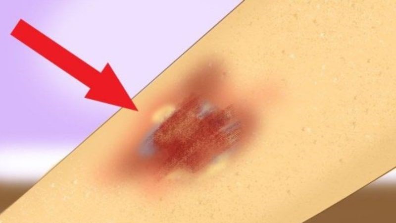 Giai đoạn sau vùng viêm mô tế bào có thể chảy dịch màu vàng