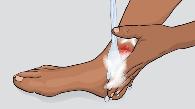 Tiến hành sát khuẩn để đảm bảo vết thương sạch sẽ
