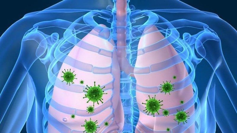 Viêm phổi là tình trạng nhu mô phổi bị các tác nhân tấn công gây viêm