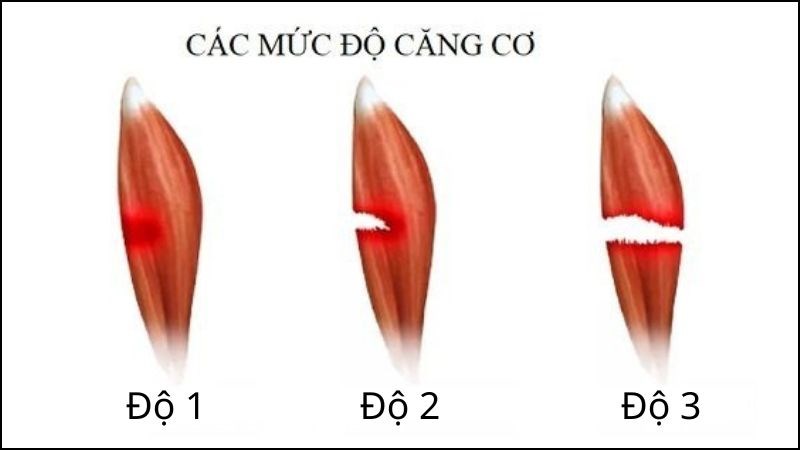 Có ba mức độ căng cơ