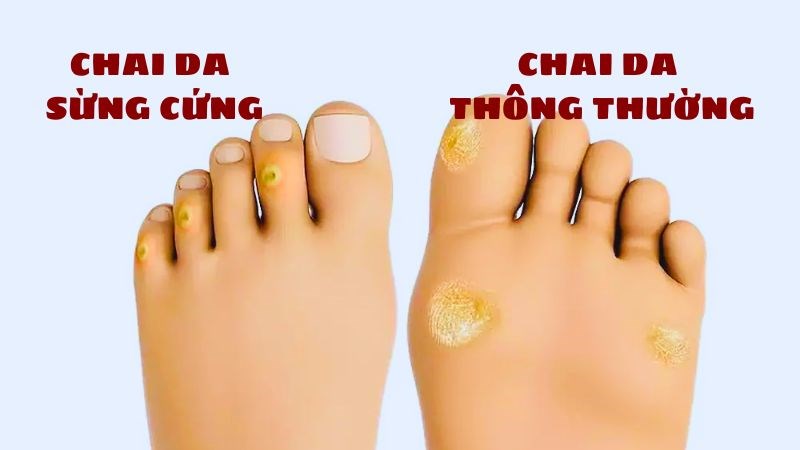 Vết chai thường được chia làm 2 loại