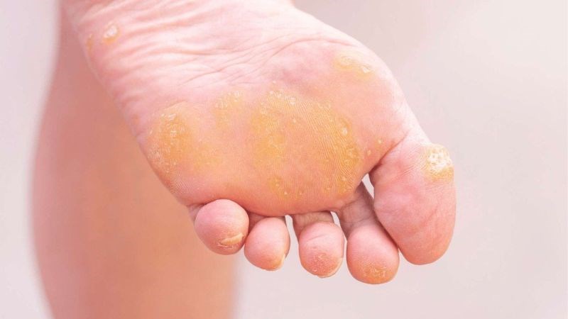 Bàn chân là vị trí dễ bị chai nhất do thường xuyên phải chịu áp lực ma sát