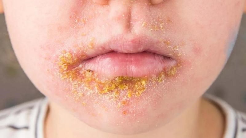 Bệnh chốc là tình trạng nhiễm trùng ở lớp nông của thượng bì Bệnh chốc là tình trạng nhiễm trùng ở lớp nông của thượng bì