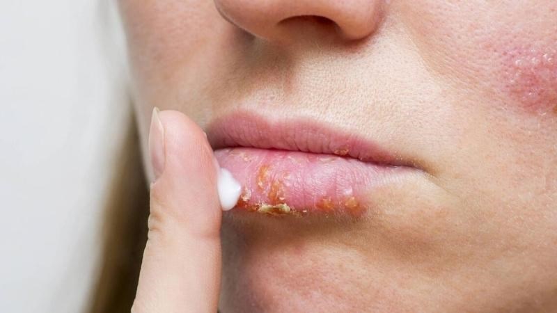 Bệnh chốc lở có khả năng lây nhiễm cao, do đó không nên tự điều trị tại nhà bằng cách loại thuốc thông thường Bệnh chốc lở có khả năng lây nhiễm cao, do đó không nên tự điều trị tại nhà bằng cách loại thuốc thông thường