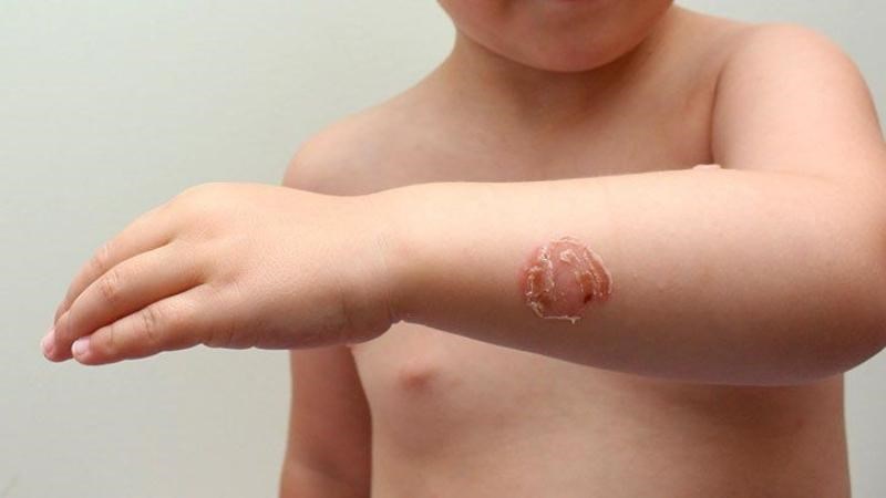 Chốc loét để lại sẹo khó lành trên da bệnh nhân Chốc loét để lại sẹo khó lành trên da bệnh nhân