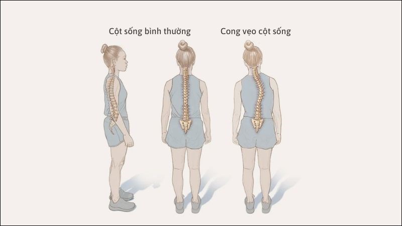 Cột sống bình thường và cột sống bị cong vẹo