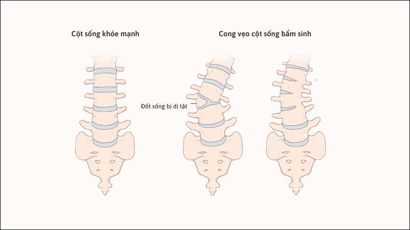 Đốt sống biến dạng trong cong vẹo cột sống bẩm sinh