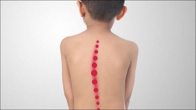 Cong vẹo cột sống làm vai không đều, xương bả vai có sự chênh lệch rõ 