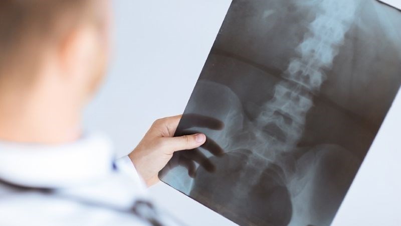 Có thể theo dõi tiến triển cong vẹo cột sống thông qua chụp X-quang