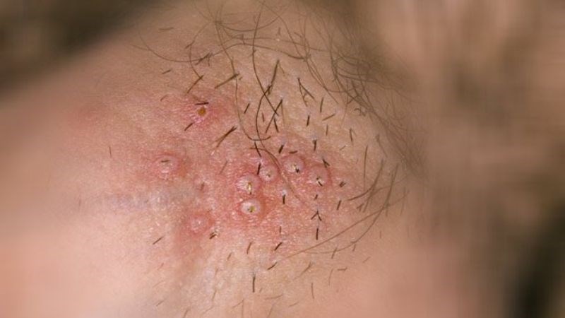 Nhiễm nấm chlamydia thường tiết mủ màu trắng, có mùi hôi vào mỗi buổi sáng