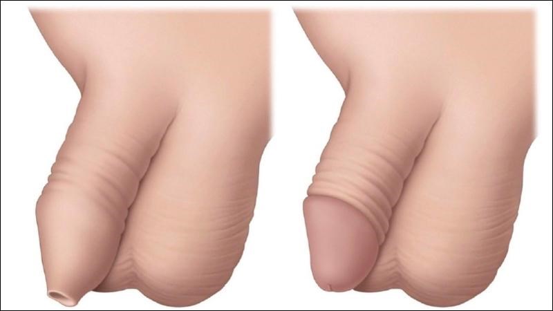 Hẹp bao quy đầu là tình trạng bao quy đầu của dương vật không thể tuột xuống khỏi quy đầu Hẹp bao quy đầu là tình trạng bao quy đầu của dương vật không thể tuột xuống khỏi quy đầu