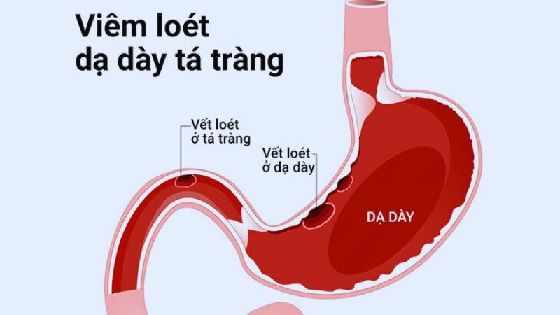 Viêm loét dạ dày tá tràng có thể gây ra tình trạng khó tiêu Viêm loét dạ dày tá tràng có thể gây ra tình trạng khó tiêu