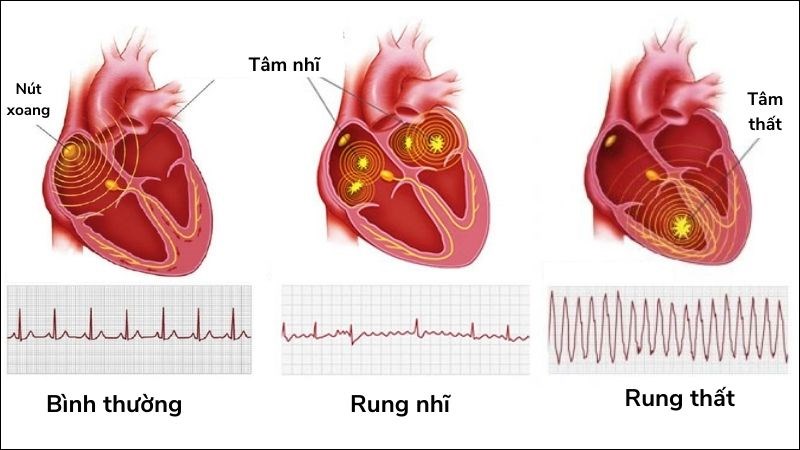Nhịp tim bình thường và nhịp tim trong rung nhĩ và rung thất