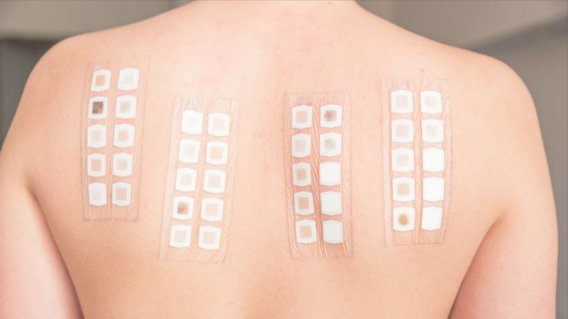 Sử dụng test áp da để tìm nguyên nhân gây bệnh