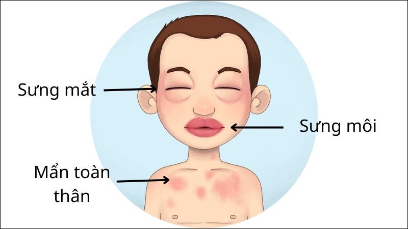 Khi có dấu hiệu sốc phản vệ nên đến ngay các cơ sở y tế