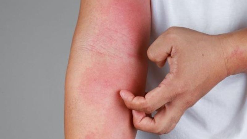 Phát ban do thuốc sẽ xuất hiện sau vài giờ hoặc vài ngày