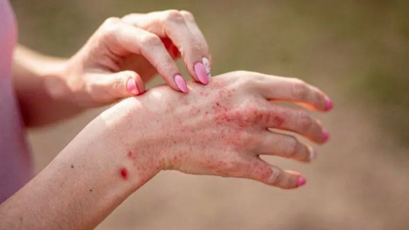 Vùng da tiếp xúc với chất gây kích ứng sẽ ửng đỏ