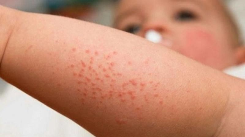 Rôm sảy thường gặp ở trẻ em do tuyến mồ hôi bị bít tắc