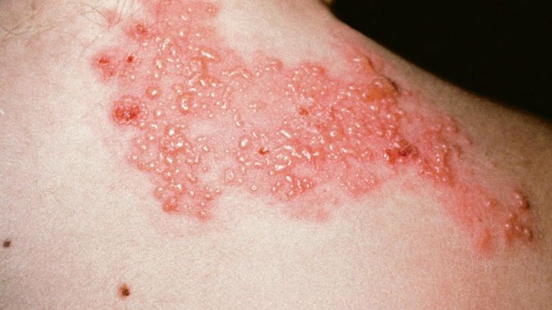 Bệnh zona thần kinh do virus Vacirella Zosterirus tồn tại ở dây thần kinh