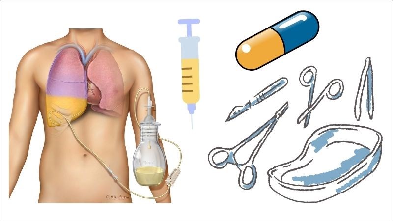 Dẫn lưu màng phổi là phương pháp điều trị thường gặp trong bệnh tràn dịch màng phổi