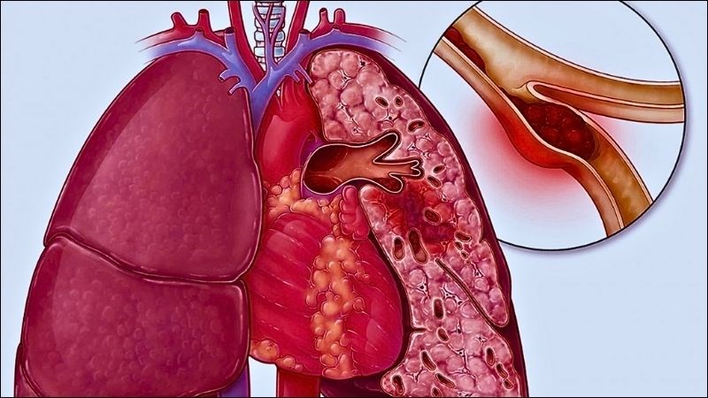 Thuyên tắc phổi gây làm tắc nghẽn quá trình trao đổi khí và lưu thông máu tại phổi