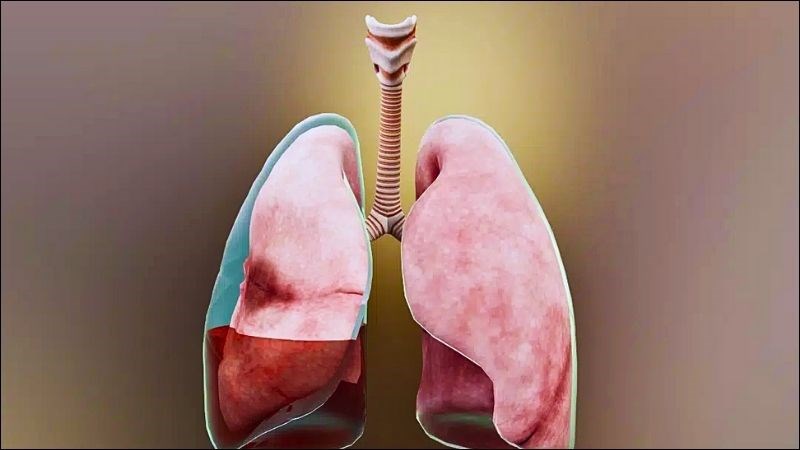 Có nhiều nguyên nhân gây tràn dịch màng phổi