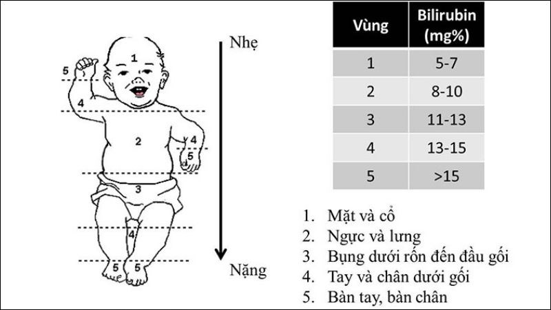 Thang điểm Krammer để phân độ vàng da sơ bộ trên lâm sàng Thang điểm Krammer để phân độ vàng da sơ bộ trên lâm sàng