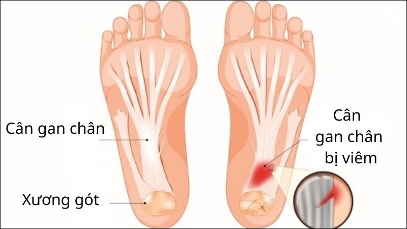Viêm cân gan chân là viêm vùng dây chằng nối gót chân và mặt trước bàn chân