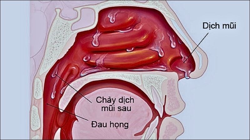 Dịch sau mũi chảy xuống họng gây nhiễm trùng và viêm 