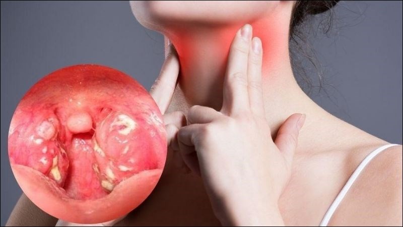 Triệu chứng viêm amidan kéo dài gây viêm họng mạn