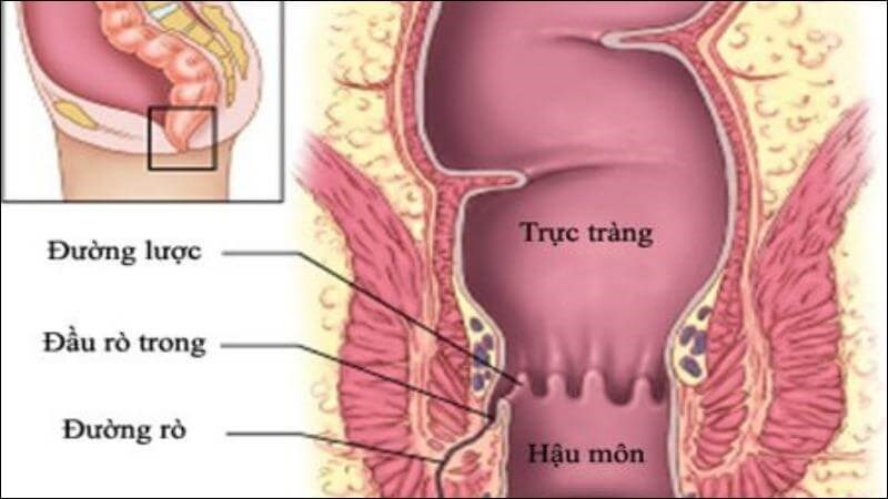 Áp xe hậu môn trực tràng là loại áp xe da thường gặp