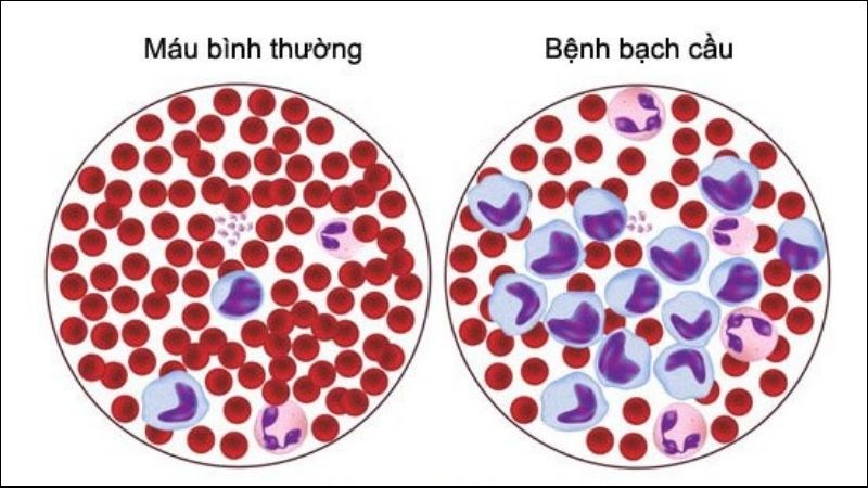 Bệnh bạch cầu lympho mạn tính là tình trạng xuất hiện nhiều bạch cầu lympho trong máu