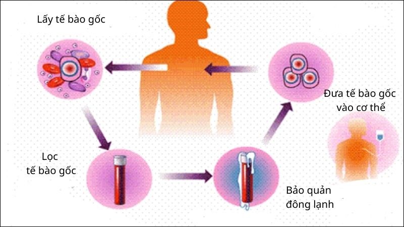Cấy ghép tế bào gốc là một trong những phương pháp ít sử dụng hiện nay