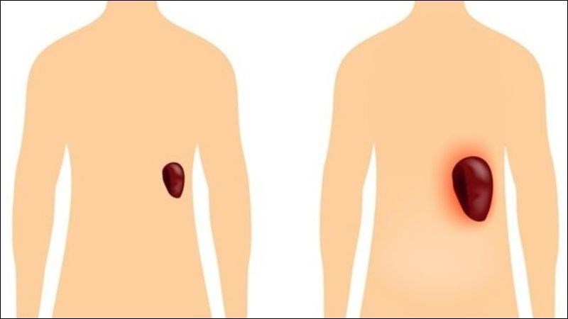 Triệu chứng gặp ở giai đoạn muộn là đau lách do lách to và sưng