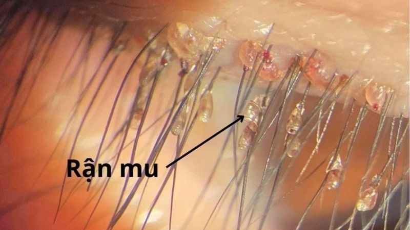 Rận mu có thể xuất hiện trên lông mi của người mắc