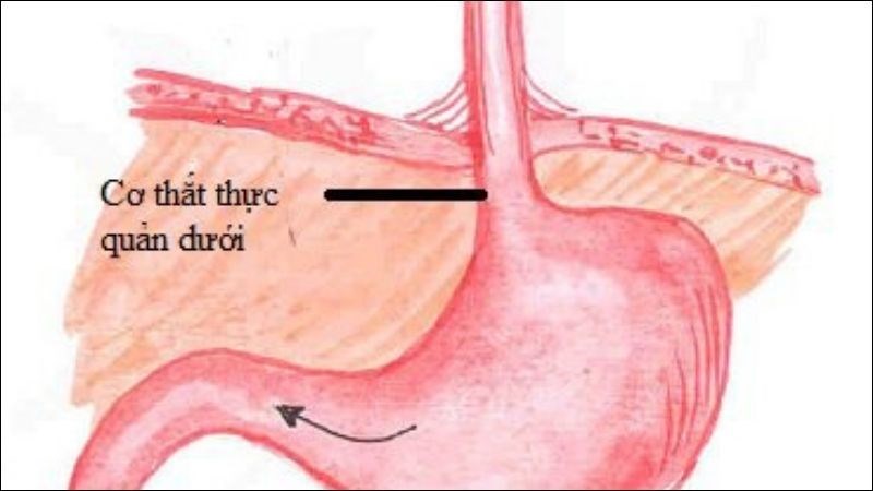 Co thắt tâm vị là tình trạng cơ thắt thực quản dưới co thắt không cho thức ăn đi xuống dạ dày