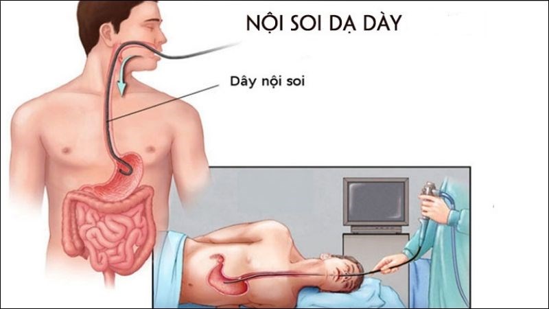 Nội soi dạ dày - thực quản có thể dùng để chẩn đoán bệnh