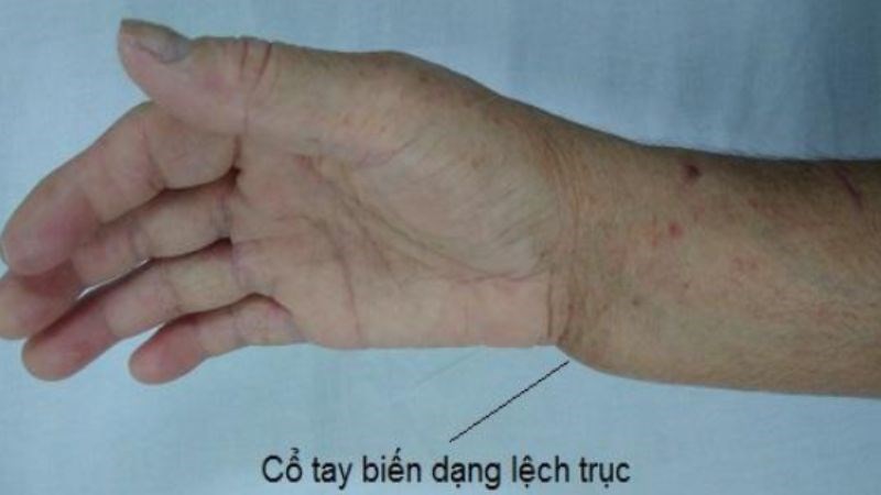 Gãy xương có thể làm biến dạng cấu trúc vùng tổn thương