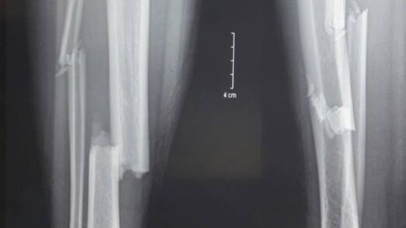 Xquang có thể nhìn thấy vùng xương bị gãy